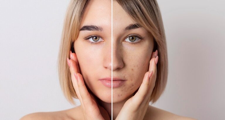 what is acne in Pune
