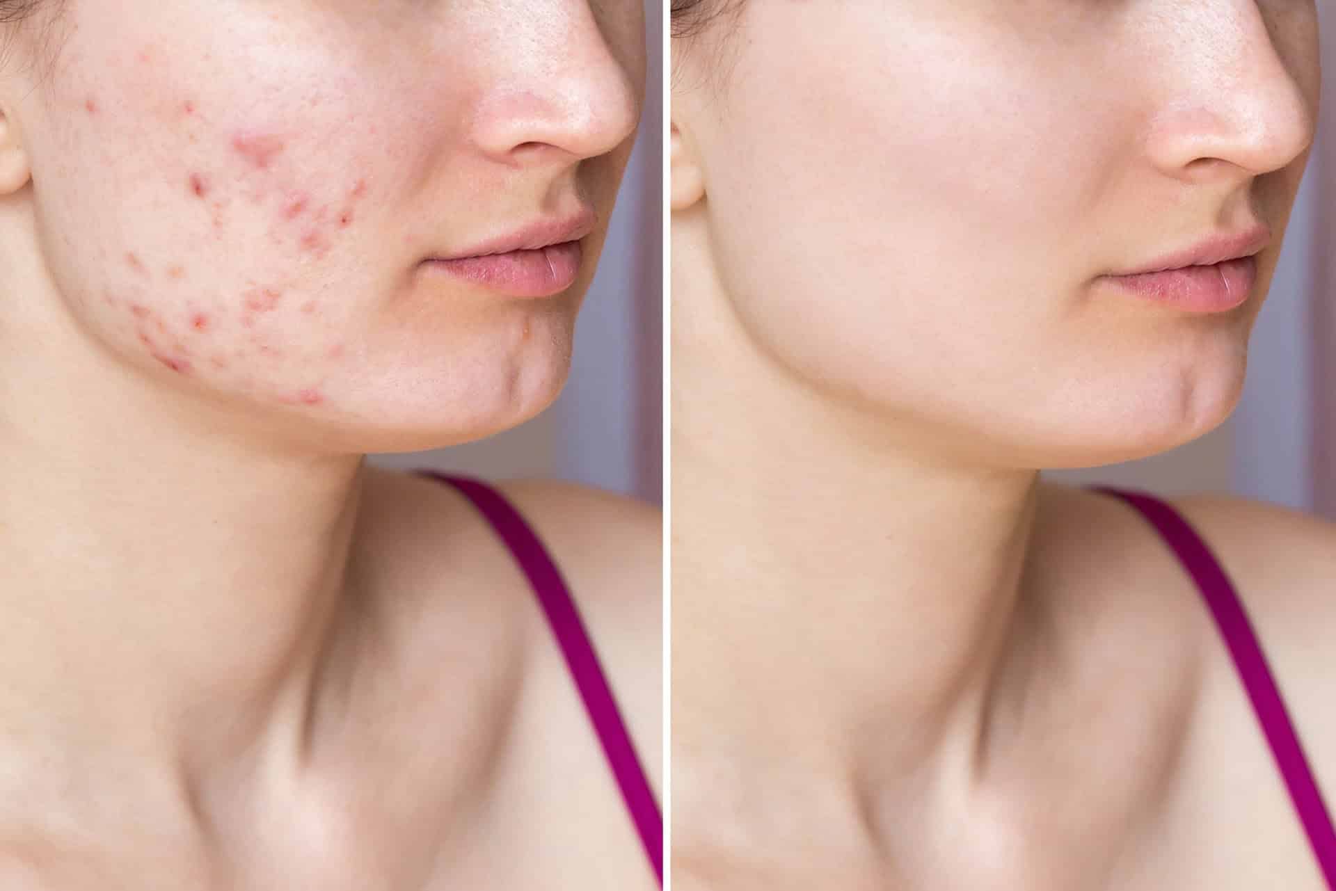 pigmentation-treatment-in-pune-laser-treatment-for-pigmentation