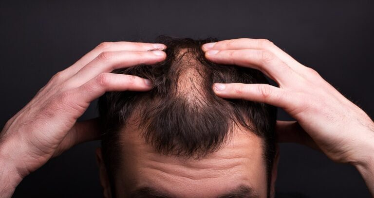 Hair loss in Men in Pune