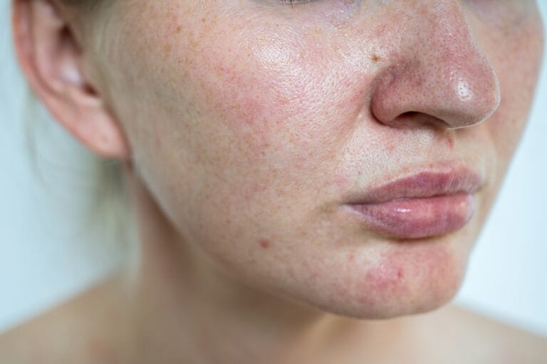 Rosacea symptoms